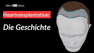 Die Geschichte der Haartransplantation Folge 2 [upl. by Enautna]