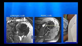 Ultrasound of SubcoracoidSubdeltoid Bursitis amp Partial vs SmallFull Thickness Supraspinatus Tear [upl. by Arhas91]