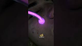 Face Acne Facial acne facial pimple [upl. by Orimar264]