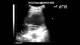 Acute lung edema [upl. by Adnaluoy]