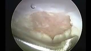 Microfracture  Fibrocartilaginous Healing  Hip Arthroscopy [upl. by Krissy841]