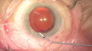 Intracameral injection of 05 mL moxifloxacin 01 [upl. by Bogosian627]