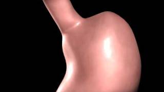 Gastric Bypass animation [upl. by Elatsyrc]