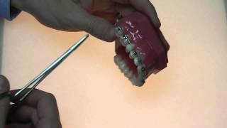 Common orthodontic emergencies Loose wire [upl. by Sally687]