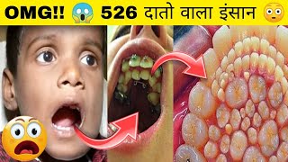 😱OMG 526 दांतों वाला इंसान 🤯 जिसे देख आपके होश उड़ जायेंगे  Boy with 526 teeth Unbelievable fact [upl. by Ogilvie]