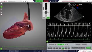 HeartWorks Global Left Ventricular Dysfunction [upl. by Cyma491]