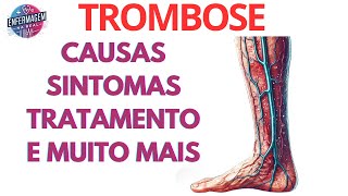 O QUE É TROMBOSE  QUAIS AS CAUSAS SINTOMAS E MUITO MAIS [upl. by Lishe]