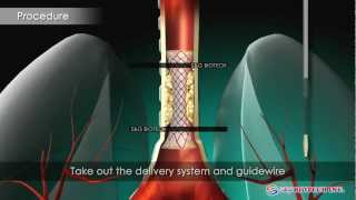 SampG BiotechEGIS Airway Stent [upl. by Eegnat]