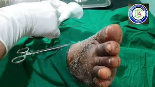 Dorsum Foot injury  Accidental axe injury foot  Kwire removal foot  Adamya Hosp videos [upl. by Oletha]