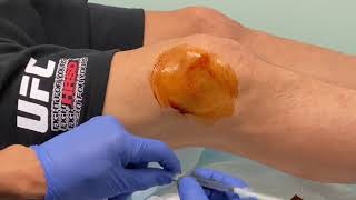 MoraMD Knee Effusion Aspiration A Nearly Painless Technique [upl. by Kerri]