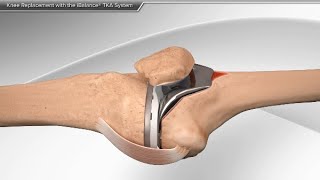 Knee Replacement with the iBalance TKA System [upl. by Almallah]