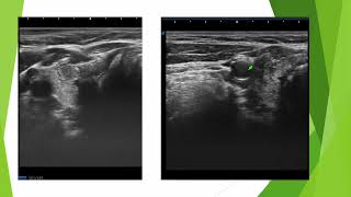 Nodule TIRADS 5 en échographie [upl. by Ylrahc890]