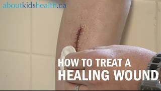 How to care for a healing wound  AboutKidsHealth at The Hospital for Sick Children [upl. by Fanny]