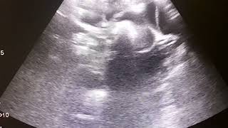 Intussusception  Saline Reduction  Ultrasound Guided  Radiology [upl. by Eelsnia]