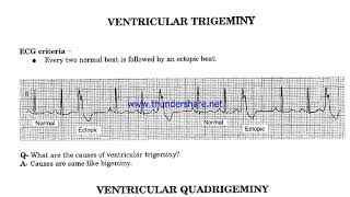 Ventricular Bigeminy Trigeminy amp Quadrigeminy [upl. by Rovit741]