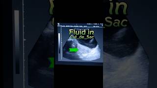 Pelvic Inflammatory Disease  PID  CuldeSac Fluid  Fluid in POD Pouch of Douglas in Ultrasound [upl. by Anela160]