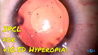 High Hyperopia Correction with IPCL Phakic Lens A StepbyStep Guide [upl. by Neenej]