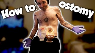 CHANGING MY OSTOMY BAG [upl. by Anahcra]