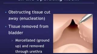 Holmium Laser Enucleation of the Prostate HoLEP for Benign Prostatic Hyperplasia BPH [upl. by Aerdnas462]