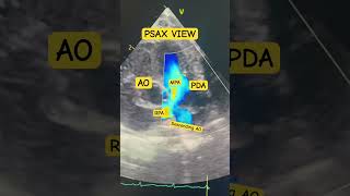 PDA Patent Ductus Arteriosus Pediatric Echo ♥️ [upl. by Svoboda]