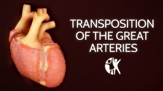 Transposition of the Great Arteries [upl. by Vladamar]