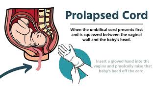 Pregnancy amp Delivery Emergencies in EMS [upl. by Omsare202]