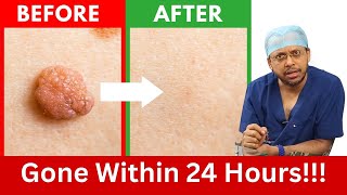 How to Rid Skin Tags and Warts Within 24 Hours  Dr Sanjay Sarkar on Skin Tag Removal [upl. by Akemak473]