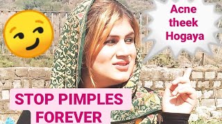 STOP PIMPLES  Dr Harneet Kaur [upl. by Aerdnak]