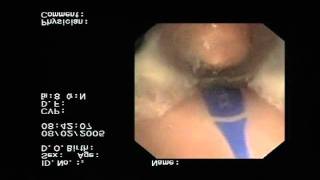 Epiglottic Blockage in Competitor Laryngeal Mask Airway [upl. by Griffith]