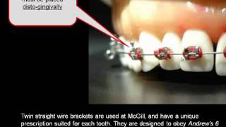 How important is the position of your orthodontic braces [upl. by Tolliver405]