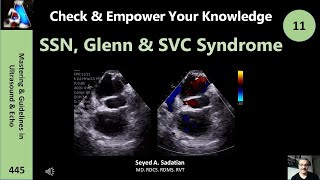 SSN window Glenn procedure amp SVC syndrome [upl. by Ilaw]