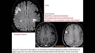 69 ICAA and ABRA CAA related inflammation amyloid beta related angiitis encephalopathy elderly [upl. by Dicks]