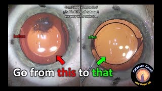 Removal of a phakic lens and then cataract surgery with a toric IOL [upl. by Eelinnej]