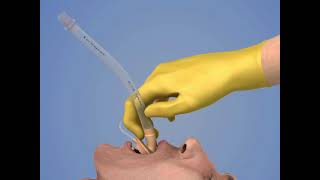 Laryngeal Mask Airway Insertion [upl. by Inalaek]