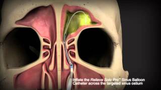 Balloon Sinuplasty Animation  Frontal Sinuses [upl. by Ahsoyem]