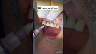 Caries removal and rehabilitation of the tooth phonk remix music genshinimpact asmrdentist [upl. by Abehsat]