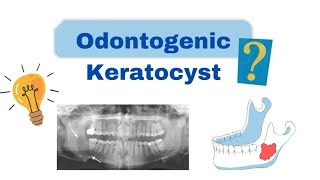 Odontogenic Keratocyst OKC  Oral Pathology  Dental lectures [upl. by Brandwein885]