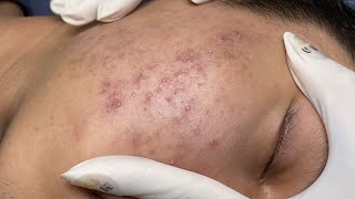 ACNE TREATMENT VU QUYNH MI  Blackheads On Boy Chin 2024FULL [upl. by Ahsillek]