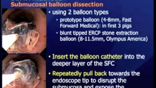 Submucosal Endoscopy With Mucosal Resection Semr A New Hybrid Technique Of Endoscopic Submucosal [upl. by Nyraf172]