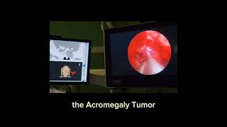 surgery for gh secreting adenoma in patient with mccune albright syndrome with fibrous dysplasia [upl. by Rustie522]