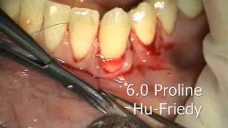 Periodontal Microsurgery AlloDerm Grafting Lower Anterior [upl. by Bradski]