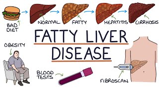 Understanding NonAlcoholic Fatty Liver Disease [upl. by Narcis]