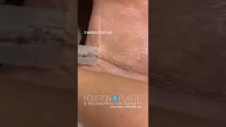 Process of Scar Healing scarhealing tummytuckrecovery tummytucksurgery plasticsurgeryresults [upl. by Eimaraj749]