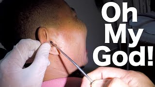 Removing Rock HARD Earwax From Mans Ear [upl. by Rapp]