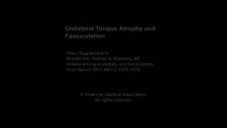 Unilateral Tongue Atrophy and Fasciculation [upl. by Remat]