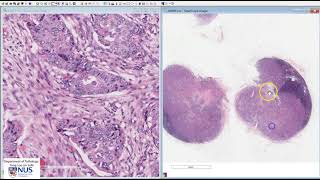 Breast Invasive carcinoma NST with lymph node metastases Microscopy Talking slide [upl. by Atolrac704]