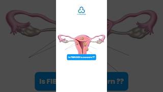 NonSurgical Fibroid Treatment Safe FDAApproved Solution  C3 Medicares Holistic Approach✨ [upl. by Turmel]