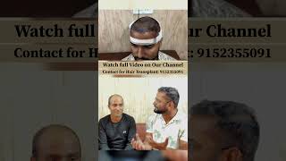 Before amp After Hair Transplant Results in Delhi haircare shorts [upl. by Yvi]