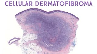 Cellular Dermatofibroma amp Hemosiderotic Dermatofibroma Oregon Case 6dermpath pathology dermatology [upl. by Bouldon]