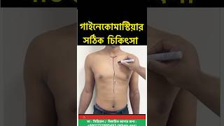 Gynecomastia Surgery  35k Campaign in Bangladesh  Gynecomastia Treatment [upl. by Atteval]